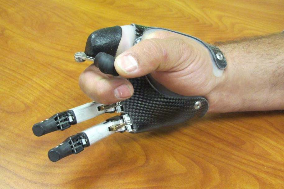 Finger And Partial Hand Prosthetic Options Arm Dynamics